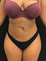 Liposuction