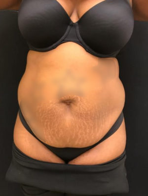 Liposuction