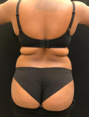 Liposuction