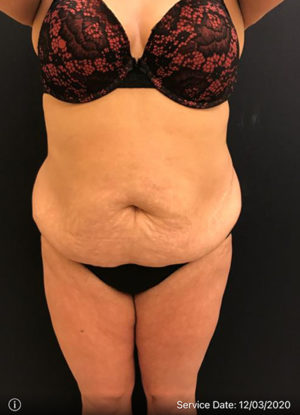 Liposuction