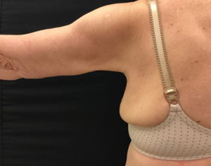 Brachioplasty