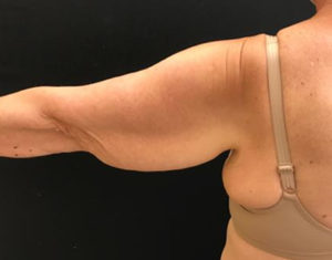 Brachioplasty