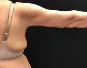 Brachioplasty