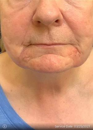 Around The Mouth Fillers