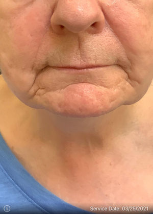 Around The Mouth Fillers