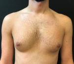 Gynecomastia