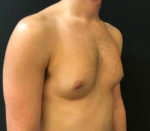 Gynecomastia