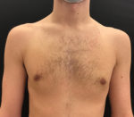 Gynecomastia