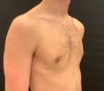Gynecomastia