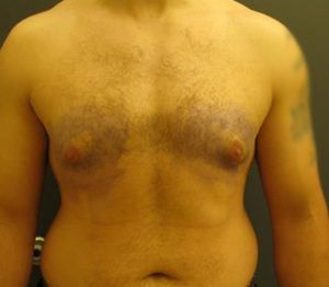 Gynecomastia