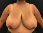 Breast Reduction