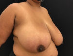 Breast Reduction