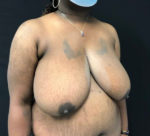Breast Reduction