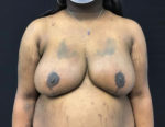 Breast Reduction