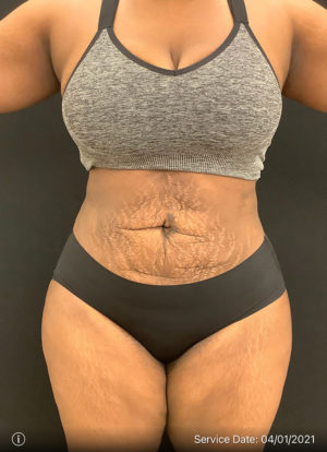 Liposuction