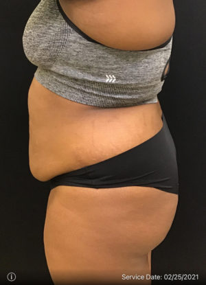 Liposuction
