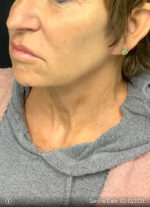 Facelift