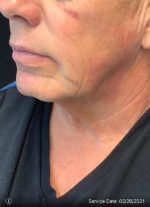Facelift