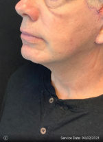 Facelift