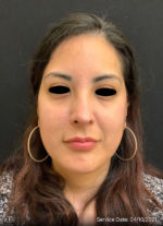 Around The Eye Fillers