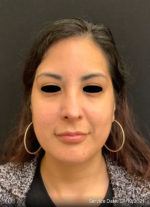 Around The Eye Fillers