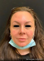 Around The Eye Fillers