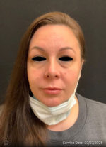 Around The Eye Fillers