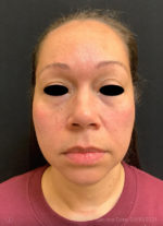 Around The Eye Fillers