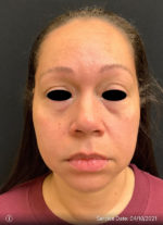Around The Eye Fillers