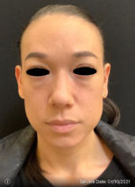 Around The Eye Fillers