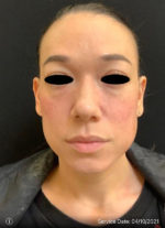 Around The Eye Fillers