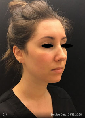 Around The Mouth Fillers