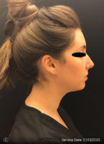 Around The Mouth Fillers