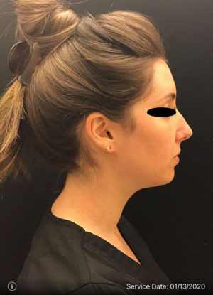 Around The Mouth Fillers
