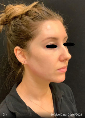 Around The Mouth Fillers
