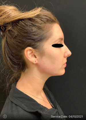 Around The Mouth Fillers