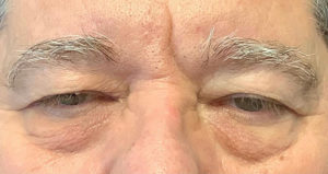 Eyelid Surgery