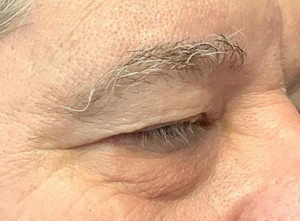 Eyelid Surgery