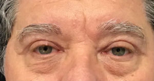 Eyelid Surgery