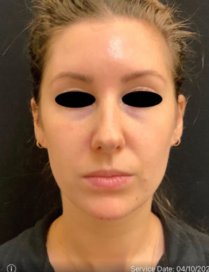 Around The Mouth Fillers