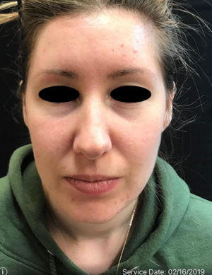 Around The Mouth Fillers