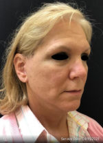 Facelift