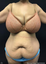 Tummy Tuck