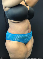 Tummy Tuck