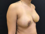 Breast Reduction