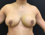 Breast Reduction