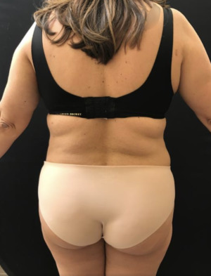 Liposuction