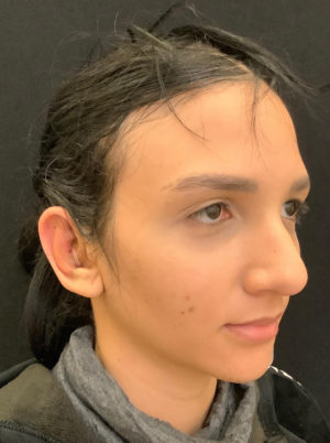 Ear Surgery