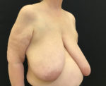Breast Reduction