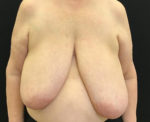 Breast Reduction